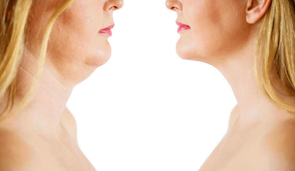 Double Chin treatment Coventry before and after results