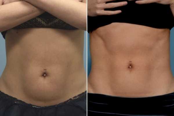 body sculpting FAQs Coventry