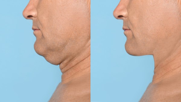Which Non-Surgical Treatments Work Best for Jowls and Loose Skin Coventry?