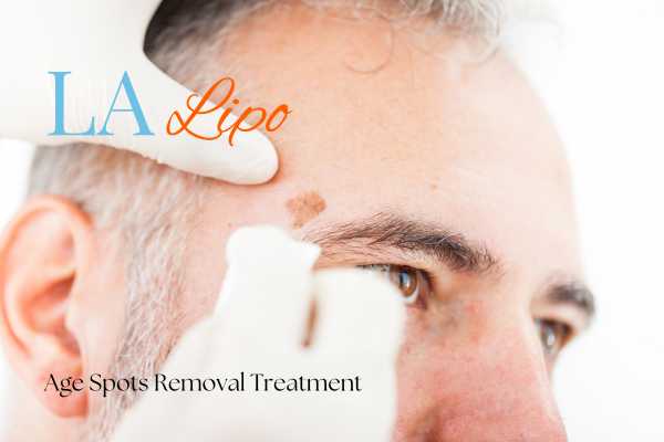 What Are the Most Effective Treatments for Age Spots Coventry?