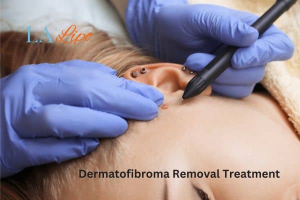 Dermatofibroma Removal Treatment Coventry