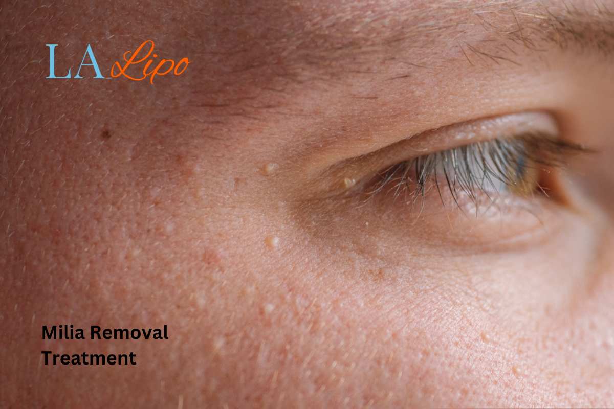 Cryopen Milia Removal: Is It the Easiest and Safest Option Coventry?