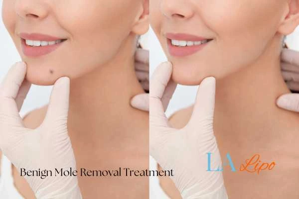 Before-and-after results following benign mole-removal treatment Coventry