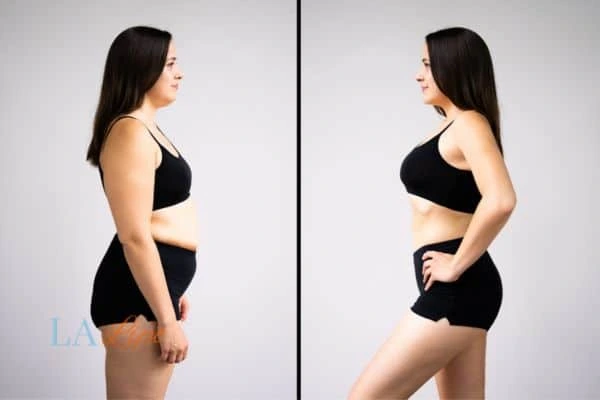 image of woman before and after results of LA-EMS Body Sculpting Coventry to help treat Diastasis recti
