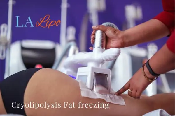 women getting fat freezing Coventry