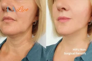 hi-fu for wrinkles Coventry before and after results