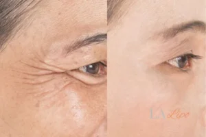 Before and after results of woman - HI-fu wrinkles reduction treatment Coventry