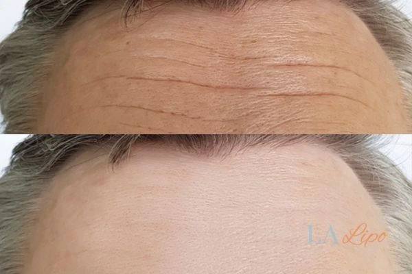 results of HIFU Coventry on mans forehead to help reduce lines and wrinkles