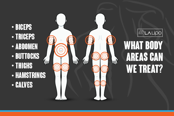 Graphic to show areas you can have LA-EMS Body Sculpting Coventry treatment.
