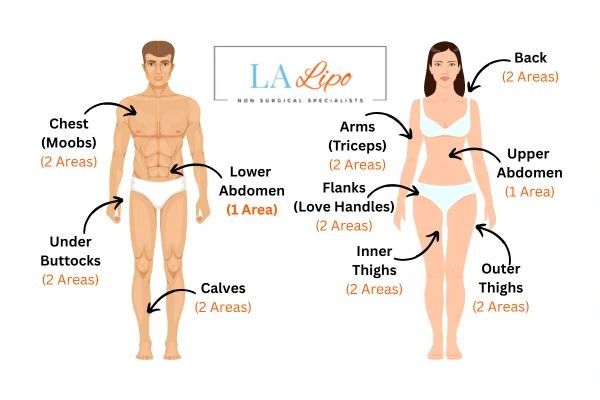 LA LIPO Cryolipolysis Areas Coventry