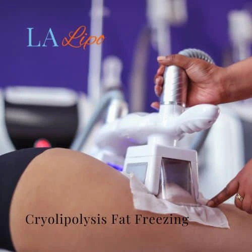 fat freezing - Cryolipolysis Coventry