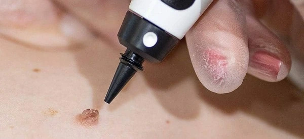 skin tag removal using cryopen Coventry