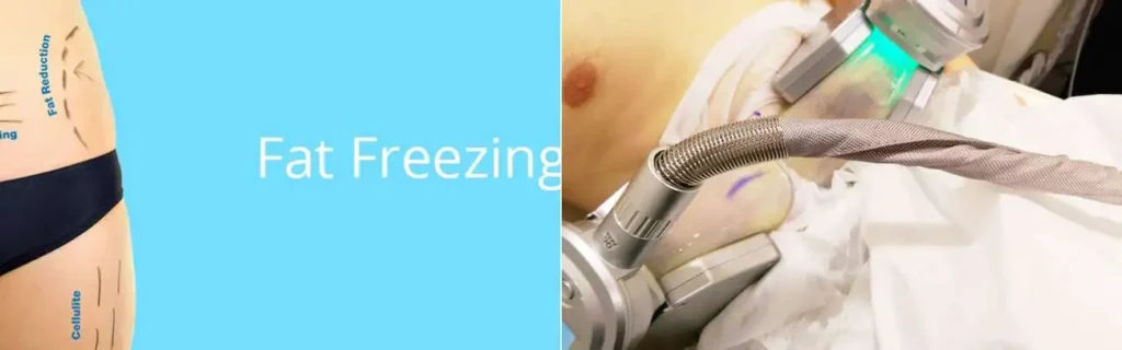 Fat freezing Coventry on multiple areas of the body