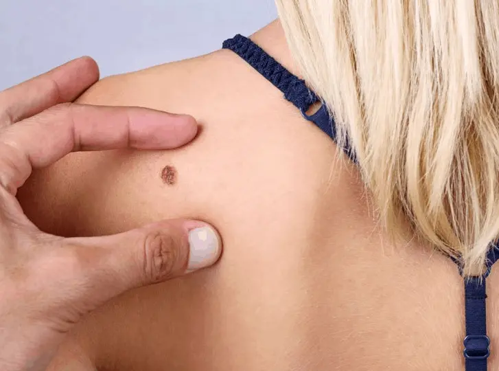 woman having mole removal Coventry consultation before treatment.