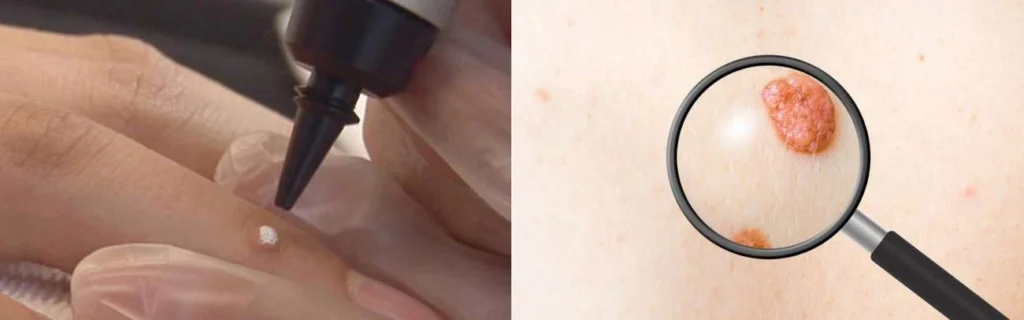 CryoPen practitioner Coventry assessing a benign mole before treatment