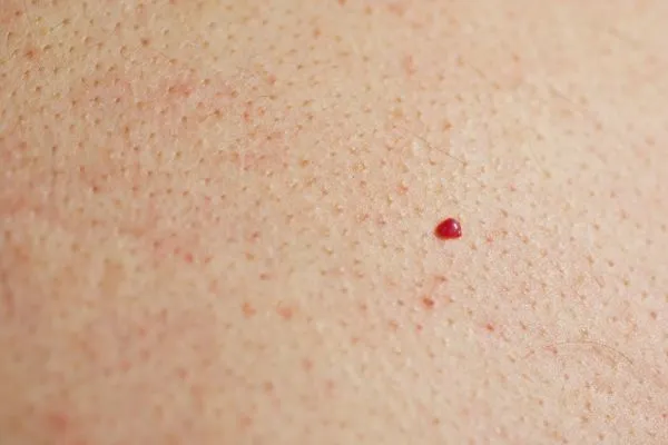 close up of a cherry angioma Coventry