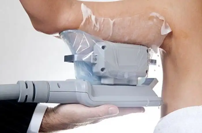 Picture of fat freezing Coventry on the upper arms.