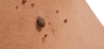 image of a skin tag Coventry