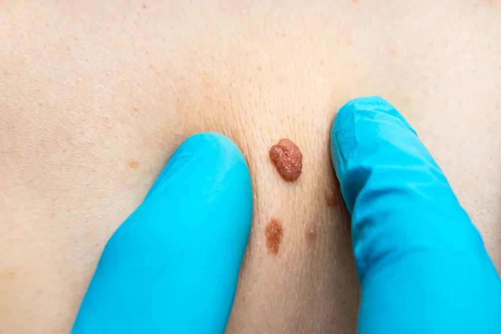 Consultant examining a skin tag Coventry