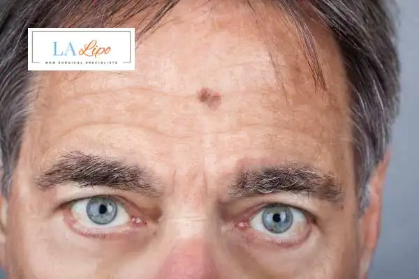 Solar Lentigo Removal Coventry image of man with mark on his forehead