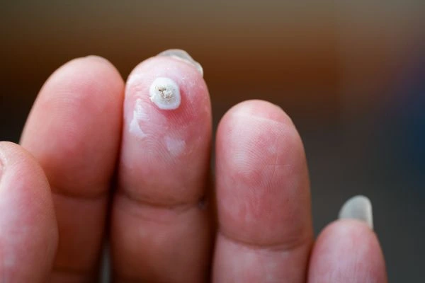 wart on person finger - cryotherapy to treat from LA LIPO Coventry