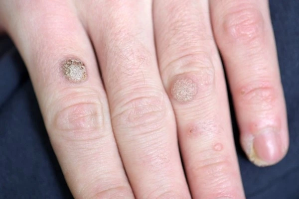 photo of warts on person hand - see wart removal Coventry from LA LIPO
