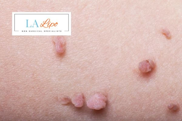 Does cryopen skin tag removal Coventry hurt? Find out now call our team today!