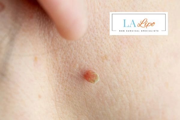 Book skin tag removal Coventry today speak to our team now!