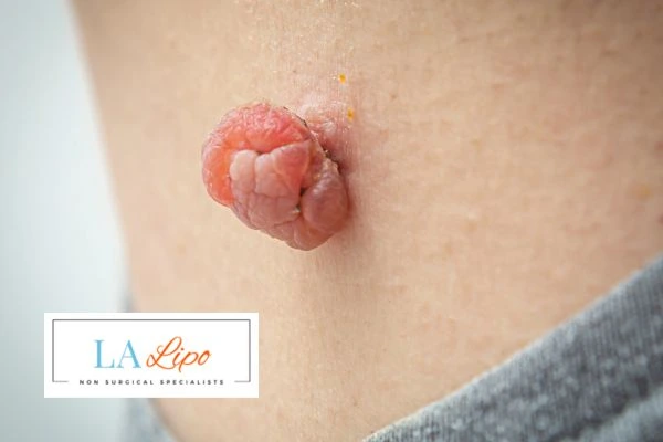 Interested in skin tag removal Coventry? Concerned about the pain? Find out more today!