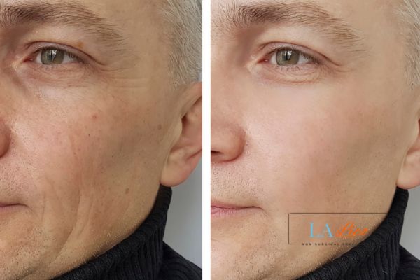 See the amazing results of Morpheus8 Treatment Coventry!