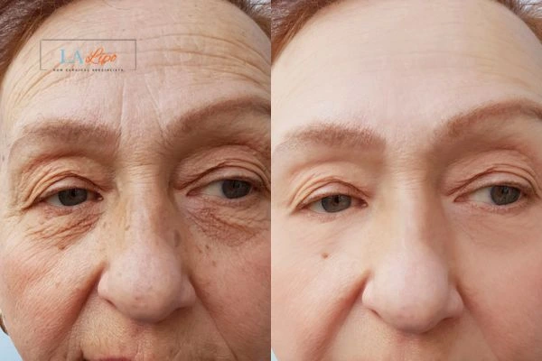 The powerful benefits of Morpheus8 Treatment Coventry - Call Our team today!
