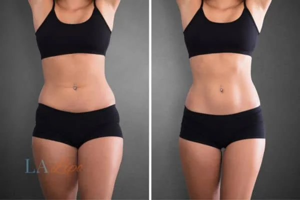 before and after results of non-surgical treatment to help a woman's body image and mental health Coventry