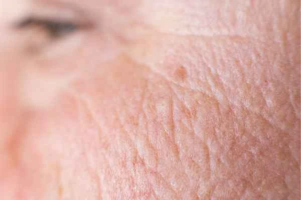 close up picture of a woman's face showing an age spot Coventry