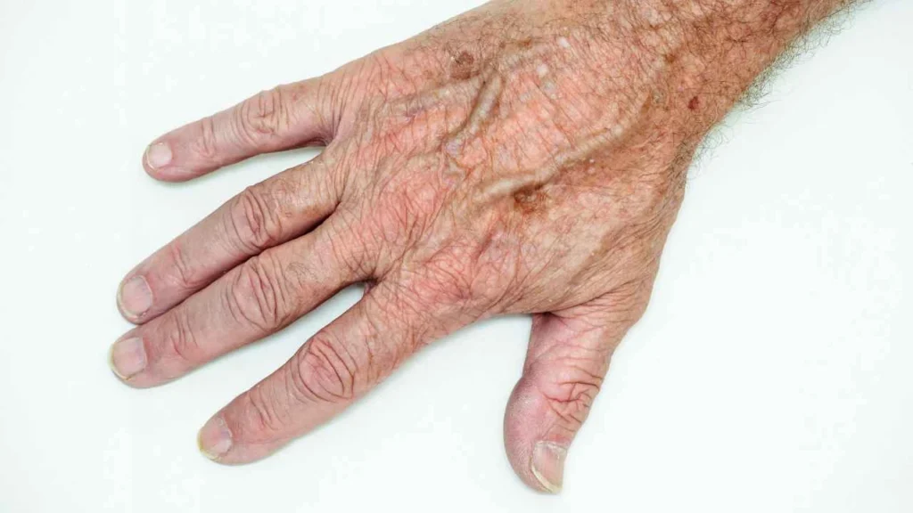 Male hand showing age spot Coventry