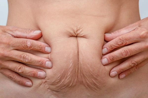 Should I Combine Diastasis Recti Treatment with Body Contouring for Better Results Coventry?