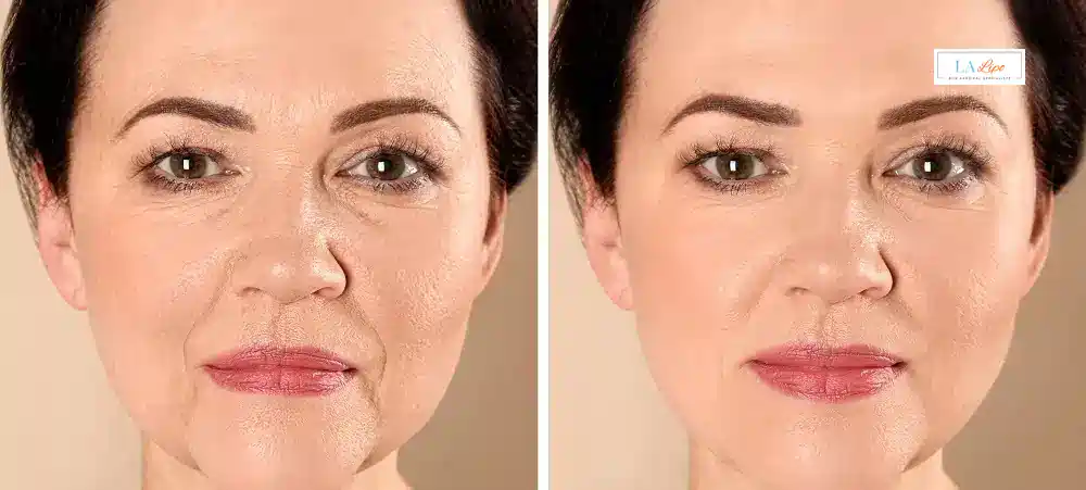 How Long Does It Take to See Results and How Long Do They Last Coventry?