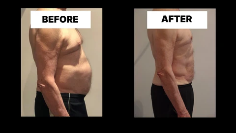 What Symptoms Can Diastasis Recti Cause in Men? Weak Core, Back Pain and Poor Posture Coventry